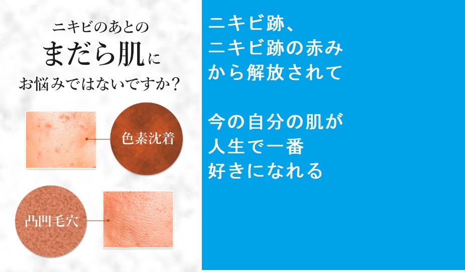 【損をしたくない方限定】C-マックスローションのお取り扱い店舗はどこが安い?最安値の通販はここ !ドンキ、薬局でも購入できるの?ニキビ跡、ニキビでもう困りたくない人のためのニキビケアの効果の秘密とは
