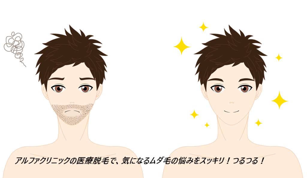 アルファクリニック 新宿院の医療脱毛の口コミ、評判で本音をチェック!【ジェントルマックスプロで最短で永久脱毛を狙います】