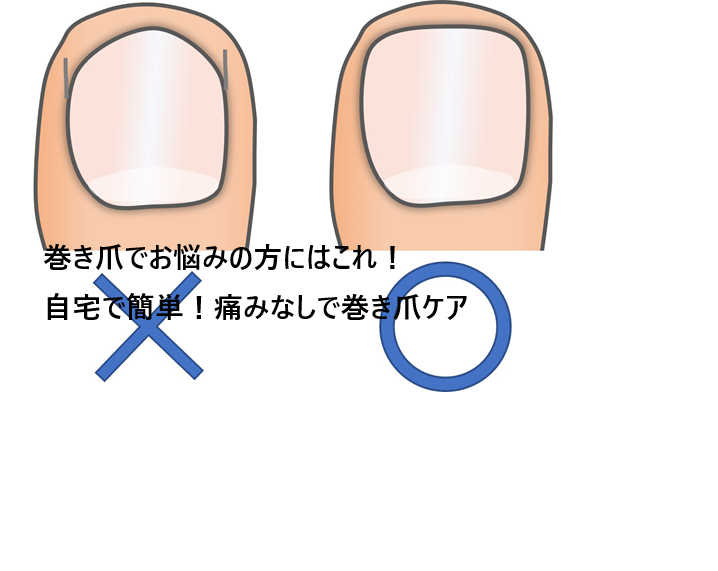 巻き爪ロボの激安通販!皆さんここで買ってます!正規品を買うならココ【自分で形を変えられる新しい巻き爪矯正器】
